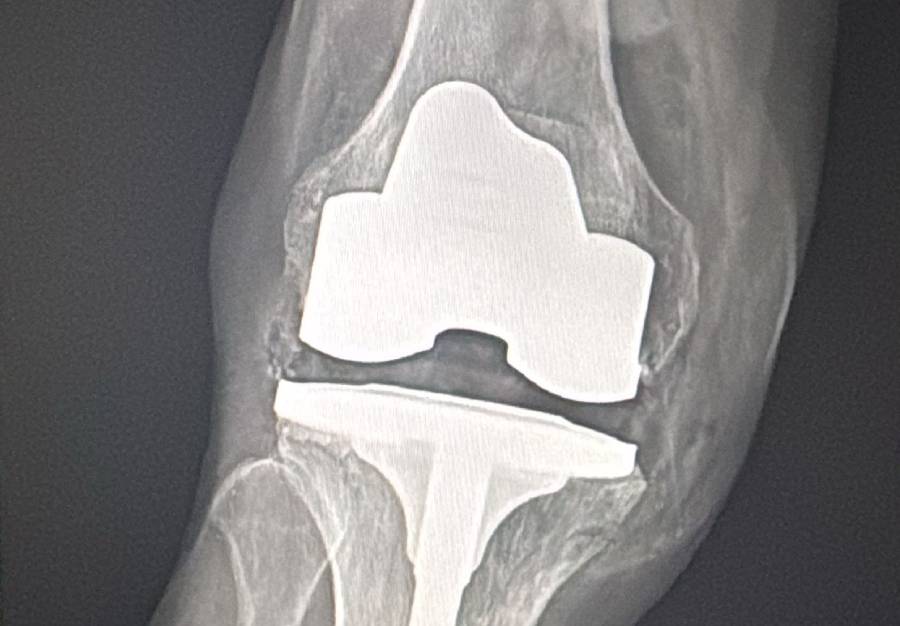 Prótesis de rodilla - Caso 3