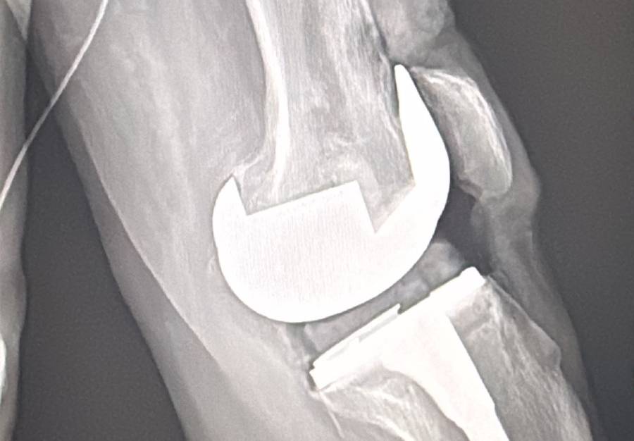 Prótesis de rodilla - Caso 2