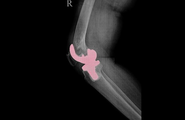Reemplazo total de rodilla